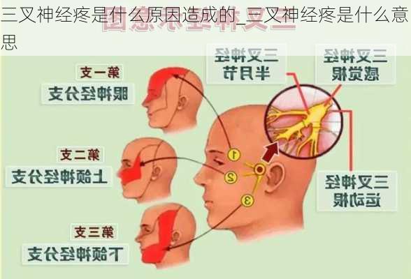 三叉神经疼是什么原因造成的_三叉神经疼是什么意思