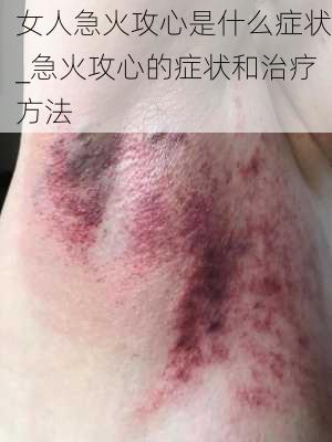 女人急火攻心是什么症状_急火攻心的症状和治疗方法