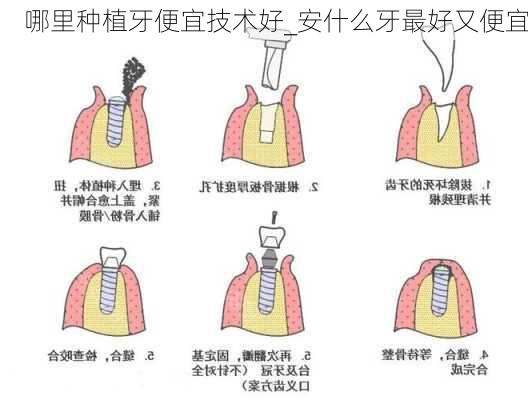 哪里种植牙便宜技术好_安什么牙最好又便宜